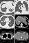 Example alternative diagnoses suggested by chest CT in patients with possible COVID-19 infection. A, Axial and, B, coronal CT images in a 59-year-old woman presenting with cough and fever for 7 days. CT images show lobar consolidation of the anterior segments of the left lower lobe with surrounding ground-glass opacities compatible with bacterial lobar pneumonia (arrows). Sputum culture confirmed Streptococcus pneumoniae pneumonia. C, Axial and, D, coronal CT images in a 53-year-old man presenting with cough and dyspnea for 3 weeks. CT images show an irregular mass in the right upper lobe with associated lymphangitic carcinomatosis and multiple hypodense liver lesions compatible with lung cancer with liver metastases (arrows). Biopsy results confirmed adenocarcinoma of the lung with liver metastases. E, F, Axial CT images in an 18-year-old woman presenting with cough and fever for 7 days. CT images show bilateral axillary lymphadenopathy and splenomegaly compatible with Epstein–Barr virus infection, which was confirmed by Epstein–Barr virus immunoglobulin M antibody detection (arrows). A–C, Window center, −600 HU; window width, 1600 HU; slice thickness, 1 mm; and increment, 0.7 mm. D–F, Window center, 40 HU; window width, 400 HU; slice thickness, 3 mm; and increment, 3 mm.