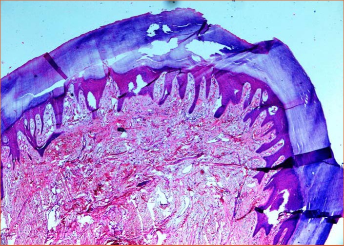 ACQUIRED DIGITAL FIBROKERATOMA - PMC