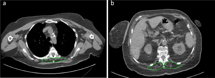 Example of severely impaired muscle status with subsequent intensive care unit admission and death. Skeletal muscle area segmentation on chest CT images at T5 level (panel a) and T12 level (panel b) of a 62 years old female COVID-19 patient. This patient presented with fever, dyspnea, mild bilateral lung parenchymal involvement (category 2 according to Bernheim et al. (17)), consolidations without groundglass opacities, no evidence of crazy paving, pleural effusion, or mediastinal lymphadenopathy. She had previous cardiovascular comorbidities, diabetes, and class I obesity. All considered laboratory tests (white blood cell count, lymphocyte count, platelet count) were within normal ranges. Muscle status parameters were however all impaired: T5 paravertebral muscle area (750 mm2), T5 paravertebral muscle density (10 Hounsfield units), T5 dorsal muscle index (2.9 cm2/m2), T12 paravertebral muscle area (2300 mm2), T12 paravertebral muscle density (5 Hounsfield units), and T12 dorsal muscle index (6.7 cm2/m2) were all in the lowest quartile of their overall distributions, with marked fatty degeneration both at T5 and T12 levels.