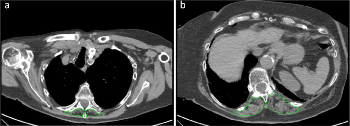 Example of severely impaired muscle status with subsequent intensive care unit admission. Skeletal muscle area segmentation on chest CT images at T5 level (panel a) and T12 level (panel b) of a 79 years old female COVID-19 patient. This patient presented with fever, cough, mild bilateral lung parenchymal involvement (category 2 according to Bernheim et al. (17)), coexistence of ground-glass opacities and consolidations, no evidence of crazy paving, pleural effusion, or mediastinal lymphadenopathy. She had no comorbidities and no abnormalities in all considered laboratory tests (white blood cell count, lymphocyte count, platelet count). Muscle status parameters were however all impaired save for dorsal muscle index at T12 level: T5 paravertebral muscle area (890 mm2), T5 paravertebral muscle density (8 Hounsfield units), T5 dorsal muscle index (6.6 cm2/m2), T12 paravertebral muscle area (2440 mm2), and T12 paravertebral muscle density (5 Hounsfield units) were all in the lowest quartile of their overall distributions.