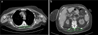 Example of severely impaired muscle status with subsequent intensive care unit admission and death. Skeletal muscle area segmentation on chest CT images at T5 level (panel a) and T12 level (panel b) of a 62 years old female COVID-19 patient. This patient presented with fever, dyspnea, mild bilateral lung parenchymal involvement (category 2 according to Bernheim et al. (17)), consolidations without groundglass opacities, no evidence of crazy paving, pleural effusion, or mediastinal lymphadenopathy. She had previous cardiovascular comorbidities, diabetes, and class I obesity. All considered laboratory tests (white blood cell count, lymphocyte count, platelet count) were within normal ranges. Muscle status parameters were however all impaired: T5 paravertebral muscle area (750 mm2), T5 paravertebral muscle density (10 Hounsfield units), T5 dorsal muscle index (2.9 cm2/m2), T12 paravertebral muscle area (2300 mm2), T12 paravertebral muscle density (5 Hounsfield units), and T12 dorsal muscle index (6.7 cm2/m2) were all in the lowest quartile of their overall distributions, with marked fatty degeneration both at T5 and T12 levels.