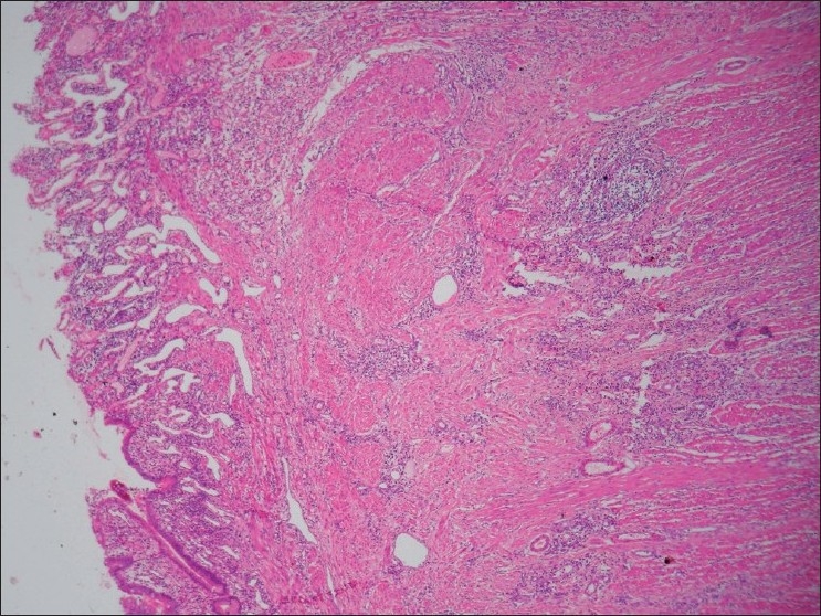 Neuromuscular and Vascular Hamartoma of the Small Bowel: A Rare Cause ...