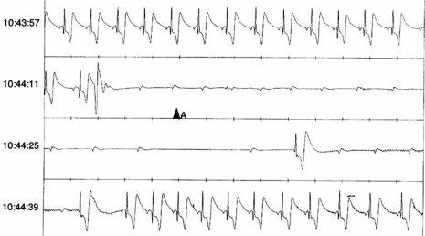 Fig. (6). Manual Event Detection from an ILR.