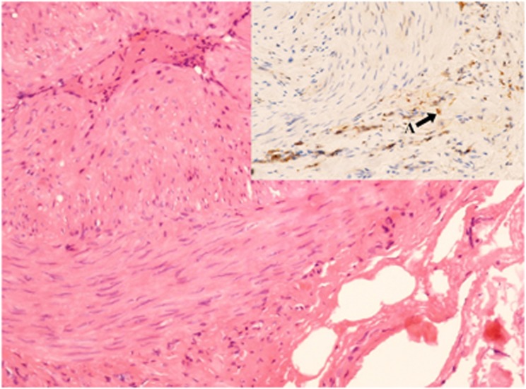 How Common Is Inflammatory Marker-negative Disease In Giant Cell ...