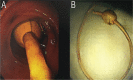 Figure 2 A & B: