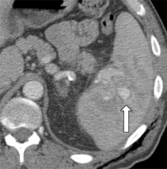 Contrast-enhanced CT images show examples of contained vascular injuries (CVIs) and active splenic hemorrhage (ASH). Axial contrast-enhanced CT scans in the (a) portal venous phase and (b) delayed phase in a 56-year-old man after a motor vehicle collision show a CVI in the portal venous phase (arrow), which does not persist on more delayed imaging. Axial contrast-enhanced CT in the (c) arterial phase and (d) portal venous phase in a 51-year-old female pedestrian struck by a car showing a CVI (arrow). (e) Axial contrast-enhanced CT in the portal venous phase 12 hours later shows interval delayed splenic rupture with an intraparenchymal hematoma (*) and surrounding hemoperitoneum (arrowhead). Axial contrast-enhanced CT scans in the (f) arterial phase and (g) portal venous phase in a 26-year-old man after a motor vehicle collision show a large area of ASH (arrow) medial to the spleen (S). Axial contrast-enhanced CT scans in the (h) arterial phase and (i) portal venous phase in a 43-year-old man after motor vehicle collision show multifocal regions of ASH (arrows) on the lateral aspect of the spleen.