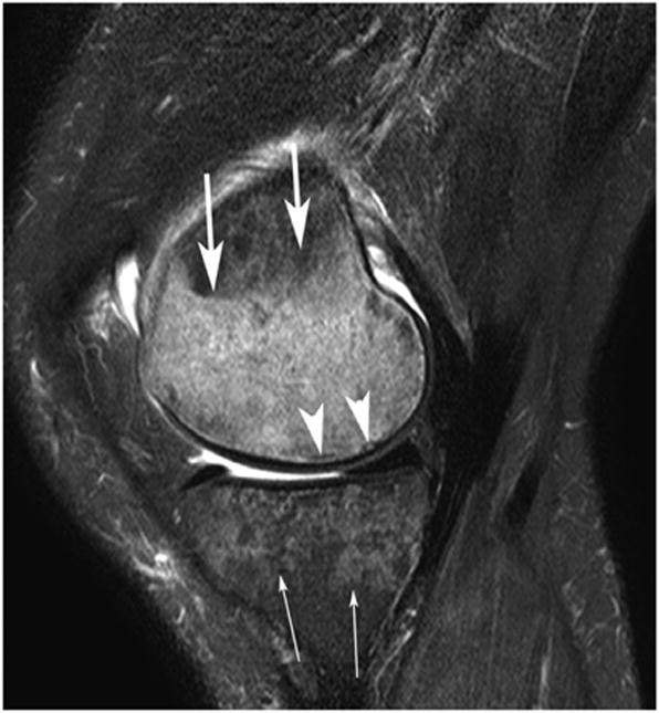 Causes of subchondral signal alterations of the knee joint, not due to osteoarthritis