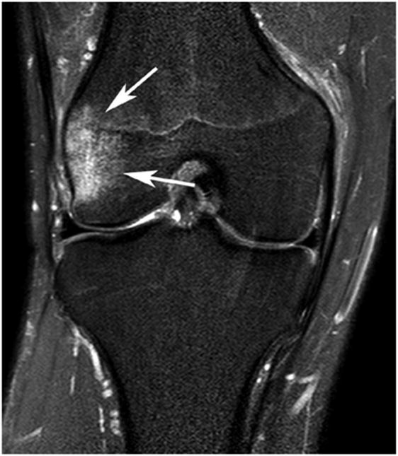 Causes of subchondral signal alterations of the knee joint, not due to osteoarthritis