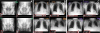 (A) Marker detection on pelvic radiographs. Note that the marker areas
were obfuscated to ensure patient privacy. (B, C) Results of the localizer
model's performance on out-of-domain chest radiographs before (B) and
after (C) fine-tuning. The red boxes are zoomed-in versions of the marker areas
that were detected. As shown, the fine-tuned model draws tighter bounding boxes
with fewer nonmarker areas and also has more specificity, not mistaking
nonmarker densities, like electrocardiography leads, compared with the initial
model.