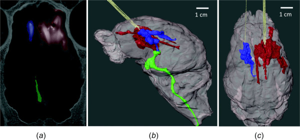 Volumetric segmentation with avizo. (a) Voxels with grayscale value corresponding to ≥ 10% of iohexol concentration were selected to derive Vd for the single-port catheter (blue) and arborizing catheter (red). The volume of solution that leaked into the ventricles was segmented into a separate mask (green). (b) Volumetric rendering of the brain and Vd for each group. (c) Volumetric rendering showing infusion volumes for the single-port catheter and the arborizing catheter after removing ventricular leakage from image.