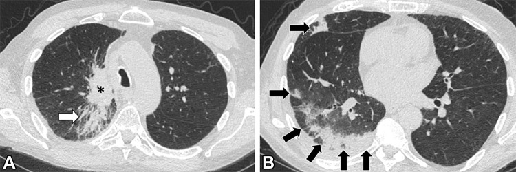 Images in a 69-year-old man with extensive stage small cell lung cancer (SCLC) treated with first-line atezolizumab plus carboplatin and etoposide. The patient also has a remote history of tracheal squamous cell carcinoma, which had been treated with chemoradiotherapy. (A, B) Chest CT scans obtained 6 weeks after initiation of atezolizumab therapy demonstrate development of peripheral areas of consolidation in the right lung (arrows in B), indicative of immune checkpoint inhibitor–related pneumonitis with an organizing pneumonia pattern. A dominant lung mass from SCLC is noted in the right upper lobe (* in A), with underlying postradiation changes from prior radiation therapy to the tracheal tumor (arrow in A). The patient had increasing shortness of breath but no fever, and results of infectious work-up, including COVID-19, were negative. Atezolizumab was held and the patient was treated with oral corticosteroids.