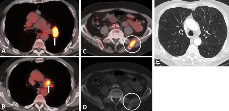 Images in an 81-year-old man who presented with cough and back pain. The patient was a former smoker. (A, B) Fluorodeoxyglucose (FDG) PET/CT scans demonstrate a left hilar mass (arrow in A) with mediastinal and left hilar lymphadenopathy (arrow in B) and bone metastasis, representing extensive stage small cell lung cancer. (C, D) Bone metastasis in the left iliac bone is better seen on PET/CT scan (C) as intense focal FDG uptake (circle in C) without definitive correlate on CT scan (D) (circle in D). (E) Chest CT scan at diagnosis also demonstrates severe centrilobular emphysema with mild peribronchial thickening in the underlying lungs in this former smoker. The patient received several lines of systemic therapy, including carboplatin and etoposide, irinotecan, and nivolumab; however, disease progressed and the patient died 10 months after the diagnosis.