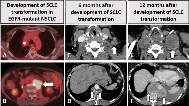 Images in a 68-year-old woman with EGFR-mutant non–small cell lung cancer (NSCLC) with small cell transformation after epidermal growth facto receptor (EGFR) inhibitor therapy. (A, B) The patient was initially treated with EGFR inhibitor, osimertinib, for her NSCLC with sensitizing EGFR mutation (L858R) and responded well, with a treated non-fluorodeoxyglucose (FDG)–avid primary tumor in the right upper lobe (* in A), as shown on FDG PET/CT scan obtained 2 years after the initiation of osimertinib (A). However, on the same FDG PET/CT scan (B), a new FDG-avid paraspinal mass (arrow in B) was noted. The paraspinal mass demonstrated mixed features of EGFR L858R mutant non-SCLC and SCLC at histologic examination, demonstrating SCLC transformation due to acquired resistance to EGFR inhibitor. The patient was treated with carboplatin plus etoposide. (C, D) Contrast-enhanced chest CT scans obtained 6 months later show further progression, with enlarged left supraclavicular node (arrow in C) and paraspinal nodes (arrows in D). The patient was switched to paclitaxel therapy, while continuing osimertinib. (E, F) Contrast-enhanced CT scans obtained at 12 months demonstrate further progression, with significant further enlargement of the left supraclavicular node (arrow in E) and paraspinal nodes (arrows in F) with heterogeneous CT attenuation and the development of left pleural effusion.