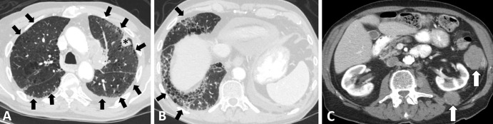 Images in a 79-year-old man with extensive small cell lung cancer (SCLC) and underling fibrotic interstitial lung disease. The patient was a former smoker and presented with worsening cough and dyspnea on exertion. (A–C) Chest CT scans demonstrate a left upper lobe lesion (* in A) and peritoneal and retroperitoneal deposits (arrows in C) that were biopsied and showed metastatic SCLC. Notably, the clinical record indicated that the annual low-dose CT screening 6 months earlier was negative for cancer. Underlying lungs show fibrotic interstitial lung disease in peripheral and somewhat basilar distribution (arrows in A and B), accompanied by interlobular septal thickening, ground-glass and reticular opacities, traction bronchiectasis, and a few areas suggestive of early honeycombing. The patient was treated with several lines of systemic therapy, including carboplatin plus etoposide and nivolumab; however, he died 6 months after the diagnosis.