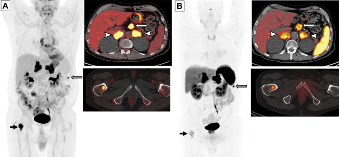 Images in a 65-year-old man with small cell lung cancer who was previously treated with carboplatin and etoposide and radiation therapy to the brain and thoracic lymph nodes. The patient presented with progression of disease. (A) Whole-body fluorodeoxyglucose (FDG) PET image (left) and fused axial FDG PET/CT scans (right) show intense FDG uptake in the bilateral adrenal lesions (arrowheads) and upper abdominal lymphadenopathy (white arrow), a peritoneal nodule (gray arrow), and a right femoral bone lesion (black arrow). FDG uptake in the bilateral paramediastinal region corresponds to the postradiation change. (B) Gallium 68 tetraazacyclododecane tetraacetic acid–octreotate (DOTATATE) whole-body PET scan (left) and fused axial PET/CT scans (right) obtained 17 days after FDG PET/CT show intense radiotracer uptake (ie, greater than the uptake in the liver) in the adrenal lesions (arrowheads) and upper abdominal lymph nodes (white arrow), a peritoneal nodule (gray arrow), and moderate radiotracer uptake (ie, similar to the uptake in the liver) in the bone (black arrow). Note a lack of DOTATATE uptake in the mediastinum in the areas of postradiation inflammatory changes, indicating high specificity of DOTATATE PET/CT for tumors compared with FDG PET/CT.