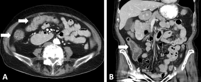 Images in a 68-year-old woman with relapsed small cell lung cancer (SCLC) after chemoradiotherapy for limited stage SCLC. The patient was treated with nivolumab and ipilimumab. (A, B) Axial (A) and coronal (B) CT images obtained 7 weeks after immune checkpoint inhibitor (ICI) therapy. Abdominal CT scans demonstrate diffuse wall thickening and increased mucosal enhancement of the ascending and transverse colon (arrows in A) and a fluid-filled lumen in the ascending colon (arrow in B), representing a characteristic appearance of ICI-related pancolitis.