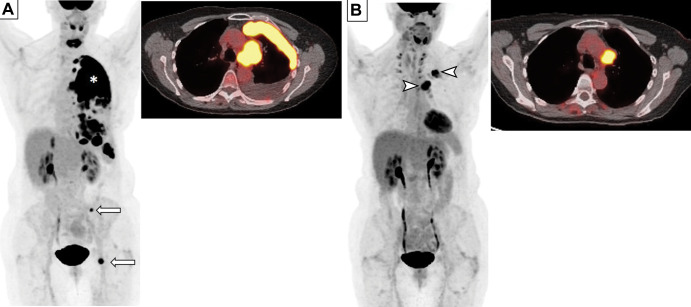 Images in a 69-year-old woman who presented with chronic cough. (A) Baseline whole-body fluorodeoxyglucose (FDG) PET scan (left) and fused axial FDG PET/CT image (right) show FDG-avid left perihilar lesion with extensive pleural metastasis (*) and osseous metastases (arrows) in the left pelvic bone, consistent with extensive small cell lung cancer. (B) Follow-up whole-body FDG PET scan (left) and fused axial FDG PET/CT scan (right) obtained after four cycles of therapy with carboplatin, etoposide, and atezolizumab demonstrate excellent response, with decreased tumor burden and residual FDG-avid disease in the left hilar region and pleura (arrowheads).