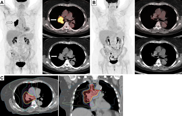 Images in a 70-year-old woman who presented with dyspnea and chest pain. (A) Baseline whole-body fluorodeoxyglucose (FDG) PET image (left), fused axial FDG PET/CT scan (top right), and CT scan (bottom right) demonstrate intense FDG uptake in the enlarged right hilar mass and nodal conglomerate (arrows) with luminal narrowing of right bronchus, consistent with limited stage small cell lung cancer. (B) Whole-body FDG PET image (left), fused axial FDG PET/CT scan (top right), and CT image (bottom right) obtained after four cycles of cisplatin and etoposide and radiation therapy show resolution of FDG-avid right hilar lesions, indicating complete response to therapy. (C) CT images used for treatment planning for radiation therapy show delineation of the gross tumor volume corresponding to the FDG-avid tumor burden on the initial PET/CT scans, for delivery of 45 Gy radiation in 30 fractions (twice daily) to the tumor.