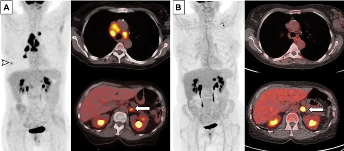 Images in a 63-year-old woman with extensive small cell lung cancer detected at screening CT. (A) Baseline whole-body PET scan (left) and fused axial PET/CT images (right) demonstrate fluorodeoxyglucose-avid right lower lobe nodule (arrowhead, whole-body PET scan) and mediastinal and hilar lymphadenopathy (fused axial image on top right) as well as left adrenal lesion (arrow, fused axial image on bottom right). First-line therapy with the programmed death-ligand 1 inhibitor atezolizimab was initiated. (B) Follow-up whole-body PET scan (left) and fused axial PET/CT images (right) obtained after four cycles of atezolizimab, carboplatin, and etoposide show significantly improved thoracic lymphadenopathy and resolution of right lower lobe nodule. However, the left adrenal metastasis (arrow) has progressed and was treated with radiation therapy.