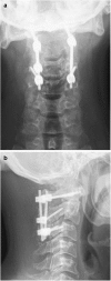 Fig. 2 Postoperative Cervical Radiographs