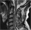 Fig. 1 Sagittal MRI of Intradural Mass