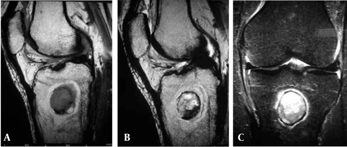 The “Penumbra Sign” on Magnetic Resonance Images of Brodie’s Abscess: A ...