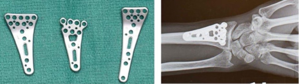 Volar plate. These come in a variety of shapes and sizes to conform to the wrist of the patient and do not need to be removed following surgery.