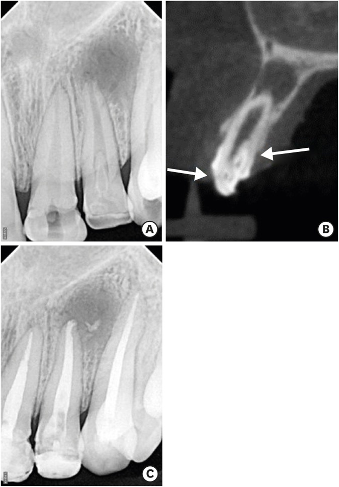 Guided Endodontics: A Case Report Of Maxillary Lateral Incisors With 