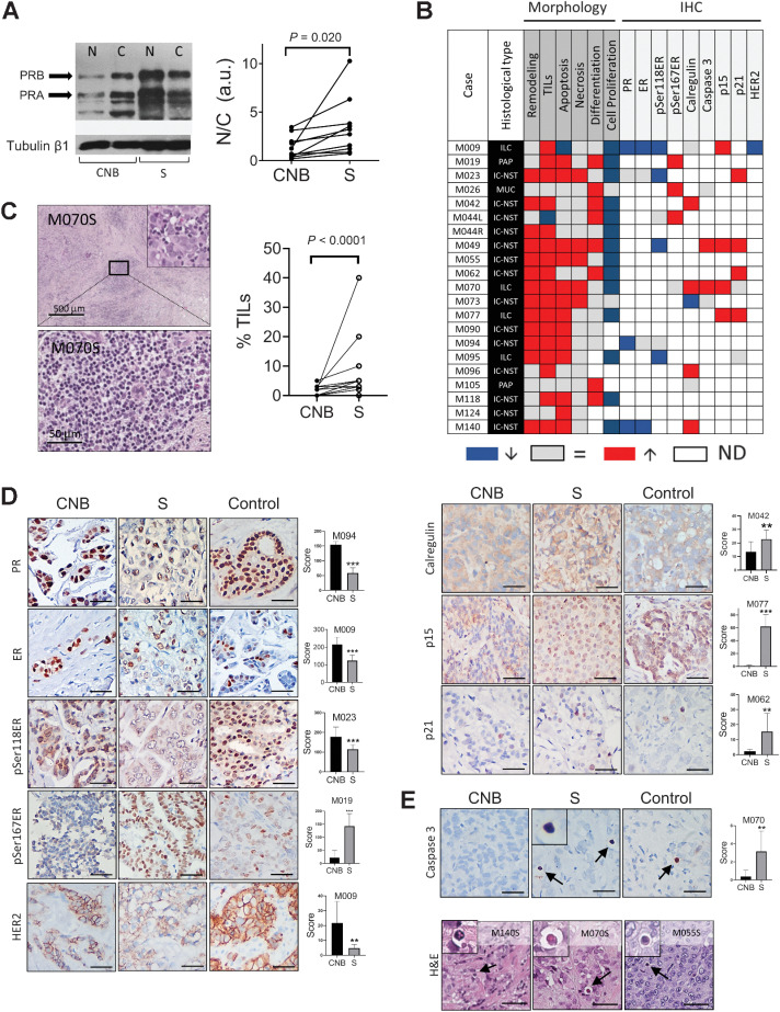 Figure 3. Western blots, morphologic, and IHC studies. A, Left, Western blot analysis of PR in the nuclear (N) and cytosolic (C) extracts of CNB and surgical samples of patient M009. Right, Total PR was quantified relative to loading control in both fractions and the relation between N/C was plotted to illustrate that after treatment PR is mainly located in the nuclei (n = 10). B, Chart summarizing morphologic changes (left columns) observed between CNB and surgical (S) samples, and summary of protein expression evaluated by IHC (right columns). Red means that higher levels were found in surgical samples compared with CNB, blue, lower levels, and gray, no changes. ND: not done (white boxes). ILC: invasive lobular carcinoma; PAP: papillary invasive carcinoma; MUC: mucinous invasive carcinoma; IC-NST: invasive carcinoma of no special type. C, Left, images of TILs after mifepristone treatment. Intratumor TILs (Inset) or stromal TILs present in the surgical sample of a patient in which almost no TILs were observed in the CNB. Right, quantification of TILs; Wilcoxon test (left). D, Representative images of IHC staining of different proteins in the CNB, in their matched surgical samples (S) and in samples from luminal breast carcinomas used as positive controls (control) n = 3–6 pairs/protein. Right, quantification of the staining in the surgical samples versus the respective CNB in each case. The score of protein expression was calculated by evaluating the staining intensity (low: 1, intermediate: 2, high: 3) and the percentage of positive cells. Bar: 50 μmol/L. E, Top, H&E of apoptotic cells in three different surgical samples. Bar: 50 μmol/L, Bottom, activated caspase 3 (Cas3) in the CNB (left), in the matched surgical sample (middle) and in a positive control (right).