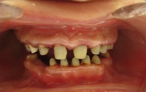 Figure 2: Crown Lengthening Post and Core,Tooth Preparation.