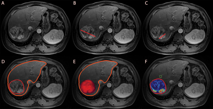 Anatomic and enhancement-based assessment methods on axial-view images. (A) Baseline arterial enhanced T1-weighted MRI scan, preprocedural for anatomic orientation. (B) One-dimensional measurement of the largest overall tumor diameter illustrated by a red line. (C) One-dimensional measurement of the largest enhancing tumor diameter illustrated by a red line. Enhancement was defined as hyperintense areas at the arterial phase that were not visible at the precontrast phase. (D) Semiautomated three-dimensional tumor and whole-liver segmentation to create a segmentation mask, which involves the entire lesion and liver. The fine red line outlines the tumor, and the thick orange line marks the liver contour. (E) Three-dimensional segmentation mask represents the total tumor volume in red at maximum intensity projection. (F) Automatically generated three-dimensional quantification of enhancing tumor volume based on image subtraction. A region of interest (green box) was placed on extratumoral liver parenchyma in the closest proximity to the tumor as a reference to calculate the relative enhancement values within the tumor. Color coding varied from red, representing maximum enhancement, to blue, representing no enhancement.