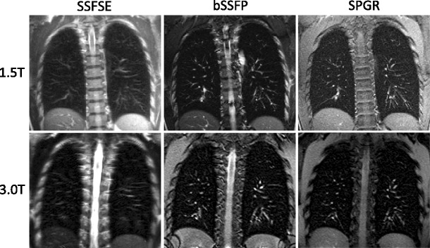 MRI of the lung (1/3): methods - PMC