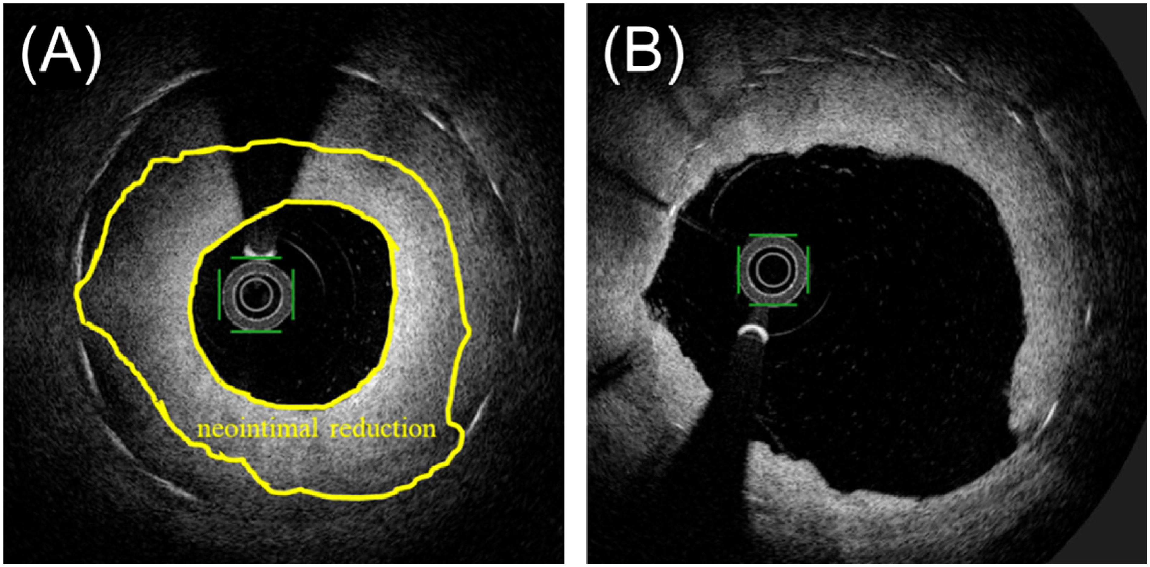 Fig. 1 A schematic illustration of the measurements of neointimal reduction. (A) pre-balloon dilatation, (B) post-balloon dilatation.