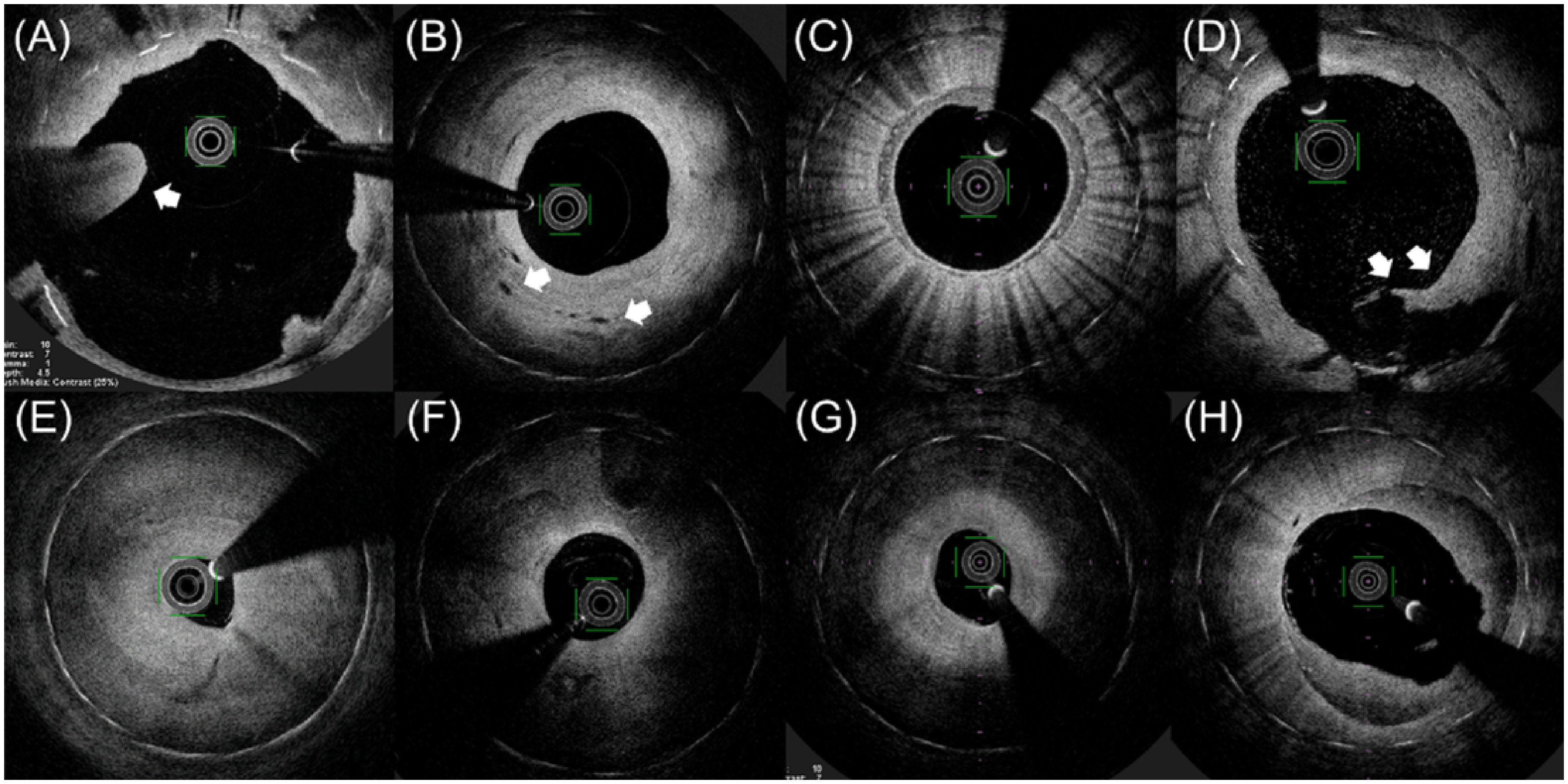 Fig. 2 Representative optical coherence tomography images. (A) thrombus; (B) vasa vasorum; (C) macrophage accumulation; (D) major dissection; (E) homogeneous ISR pattern; (F) heterogeneous ISR pattern; (G) layered ISR pattern; (H) multi-layered ISR pattern.