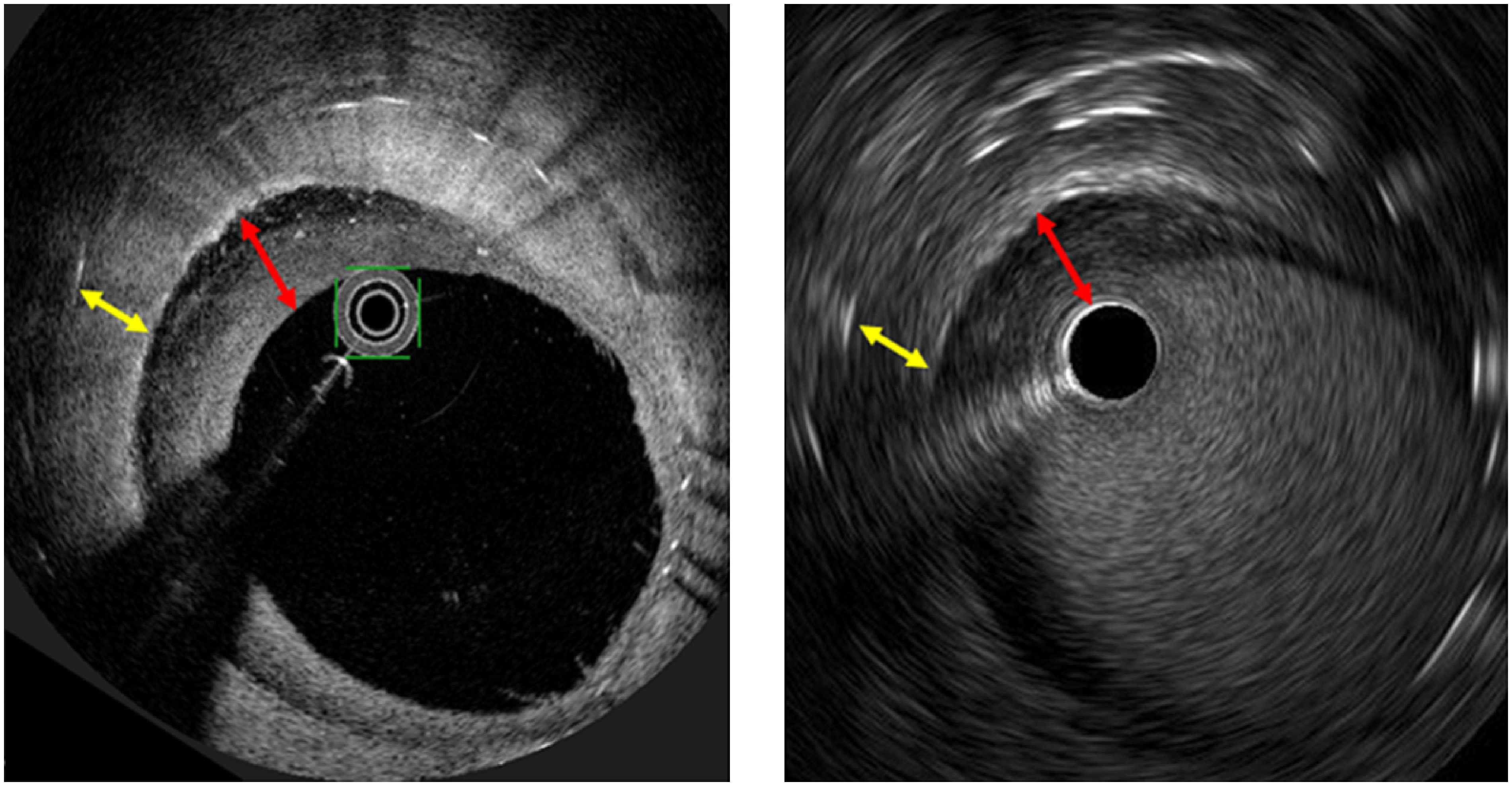 Fig. 4 Comparison of the multi-layered ISR pattern between OFDI and IVUS. (A) OFDI image, a superficial layer (red arrow), and a deep layer (yellow arrow). (B) IVUS image, a superficial hypoechoic layer (red arrow), and a deep layer (yellow arrow).