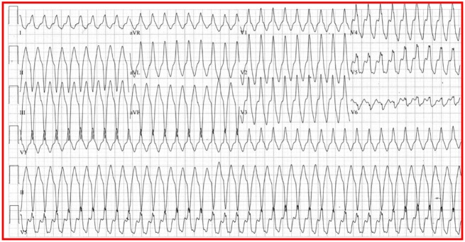 A Case Report Of Arrhythmogenic Ventricular Cardiomyopathy Presenting 