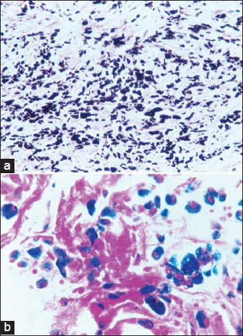 Black-pigmented sputum - PMC