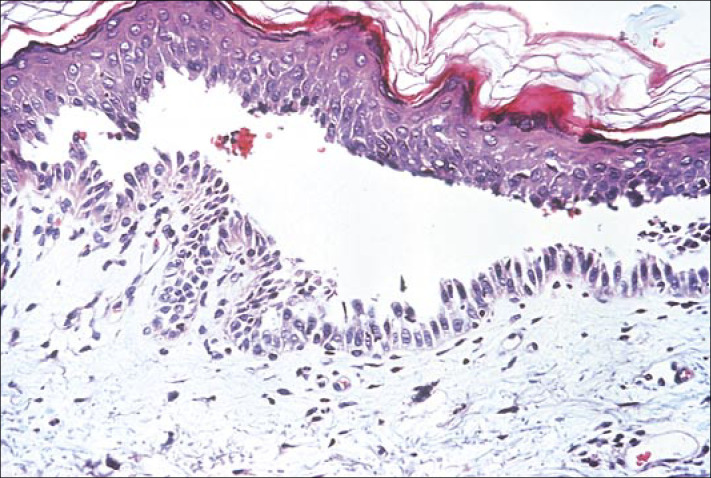 Image from the National Library of Dermatologic Teaching Slides, Geriatric Dermatology Series. Reprinted with the permission of the American Academy of Dermatology. All rights reserved.