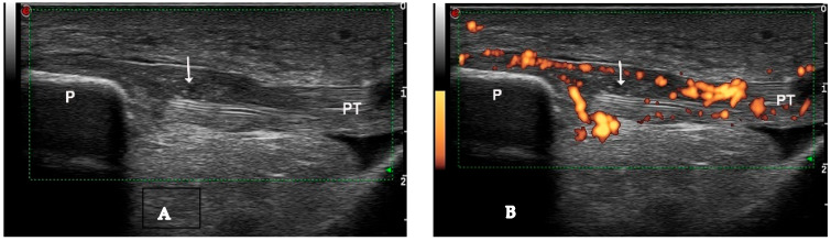 Ultrasound Features in Gout: An Overview - PMC