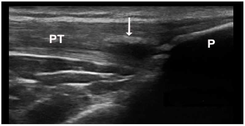 Ultrasound Features in Gout: An Overview - PMC