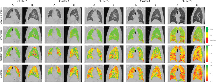 Representative (A) coronal and (B) sagittal gray-scale CT scans, disease probability maps (DPMs), Jacobian maps, and anisotropic deformation index (ADI) images from noncontrast CT scans in patients in the Severe Asthma Research Program III cohort according to cluster. For DPMs, green voxels represent normal lung tissue, yellow voxels represent functional air trapping, and red voxels represent hyperinflation. For Jacobian and ADI maps, voxels are represented on a gradient from green to yellow to red. For Jacobian maps, green voxels represent Jacobian values greater than or equal to 2.5, yellow voxels represent a Jacobian value of 1.75, and red voxels represent Jacobian values less than or equal to 1.0. For ADI maps, green voxels represent ADI values greater than or equal to 1.0, yellow voxels represent an ADI of 0.5, and red voxels represent an ADI of 0. fSAD = functional small airway disease.