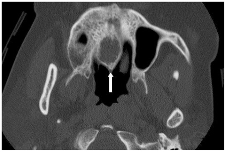 Median Palatine Cyst - PMC