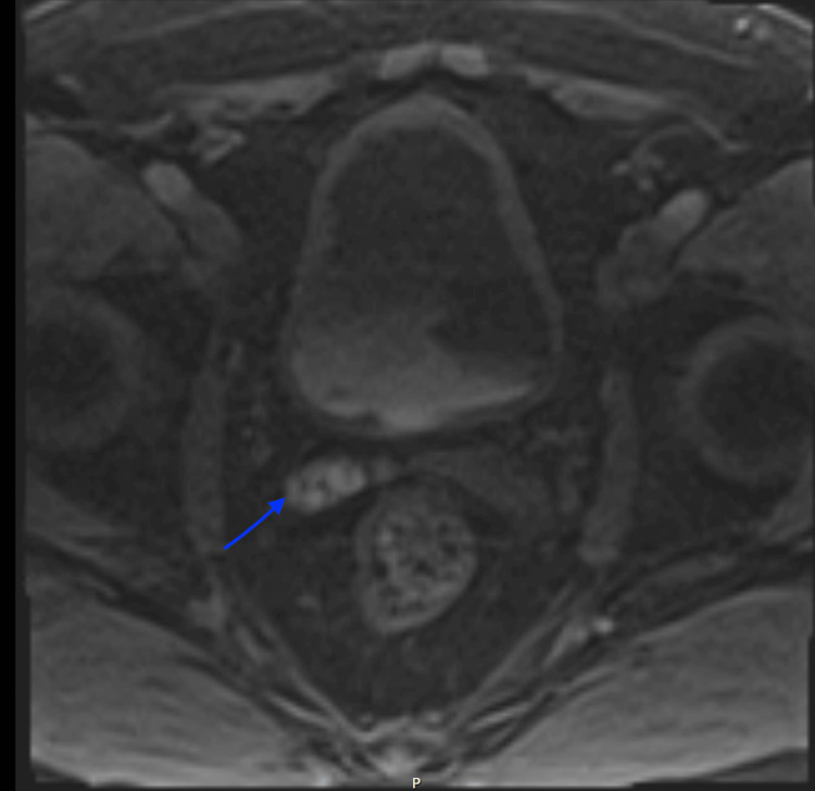 Subacute Haemorrhage in the Seminal Vesicle as a Cause of Persistent ...