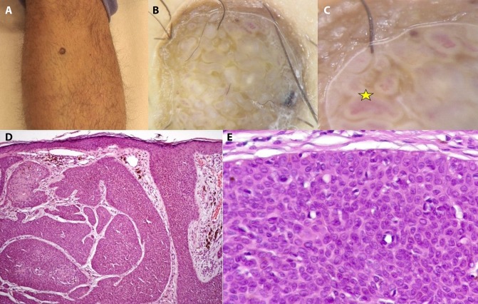 Dermoscopic–Histopathological Correlation of Eccrine Poroma: An ...