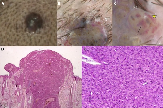 Dermoscopic–Histopathological Correlation of Eccrine Poroma: An ...