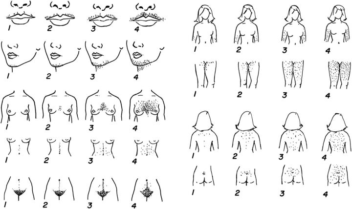 FIGURE 3. Ferriman-Gallwey hirsutism scoring system. Each of the 9 body areas most sensitive to androgen is assigned a score from 0 (no hair) to 4 (frankly virile), and these separate scores are summed to provide a hormonal hirsutism score. Generalized hirsutism (score ≥8) is abnormal in the general US and UK populations, whereas locally excessive hair growth (score <8) is a common normal variant. The normal score is lower in Asian populations and higher in Mediterranean populations.4 Reproduced with permission from Martin KA, Chang RJ, Ehrmann DA, Ibanez L, Lobo RA, Rosenfield RL, et al. Evaluation and treatment of hirsutism in premenopausal women: An Endocrine Society Clinical Practice Guideline. J Clin Endocrin Metab. 2008;93:1105–1120.35