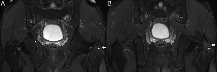 Patellar Tendon Enthesitis As Initial Manifestation Of Ankylosing 