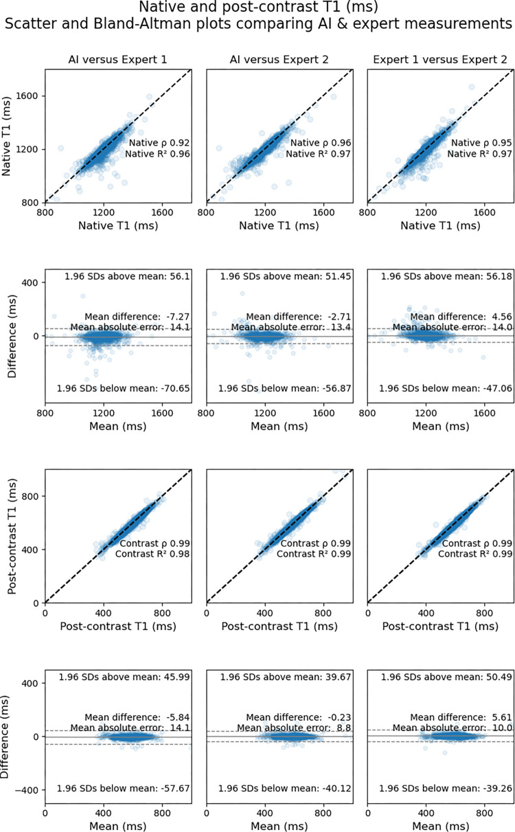 Scatterplots (first and third rows) and Bland-Altman plots (second and fourth rows) show agreement between expert-measured segment-wise T1 values across the testing dataset and those measured by artificial intelligence (AI). Measurements for native T1 maps are shown in the top two rows, and measurements for postcontrast T1 maps are shown in the bottom two rows. The upper row of each pair of rows (ie, first and third rows) shows scatterplots for comparisons between the AI solution and the expert who trained the network (expert 1) (left), between the AI solution and the expert who was not involved in network training (expert 2) (middle), and between the two experts (right). The lower row of each pair (ie, second and fourth rows) shows the corresponding Bland-Altman plots for the respective comparisons with 95% limits of agreement (dotted lines).