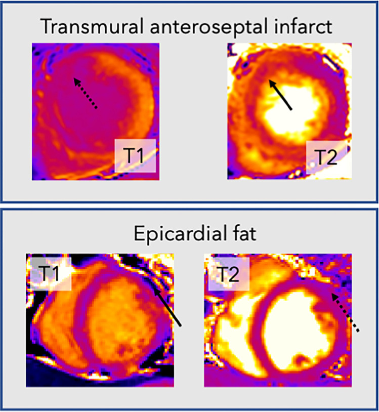 Example cardiac MR T1 and T2 images demonstrate the rationale for joint analysis of T1 and T2 mapping. Top row: T1 map (left) in a patient with transmural anteroseptal infarct shows no endocardial definition between the myocardium and blood pool in the affected region (dotted arrow), making accurate segmentation difficult. In contrast, on the T2 map (right), the boundary (solid arrow) is clearer. Bottom row: Images in a different patient. There is an area on the T2 map (right) that is of similar mapping value to the myocardium (dotted arrow). However, this area clearly represents epicardial fat on the T1 map (left), with a very low T1 value (solid arrow).