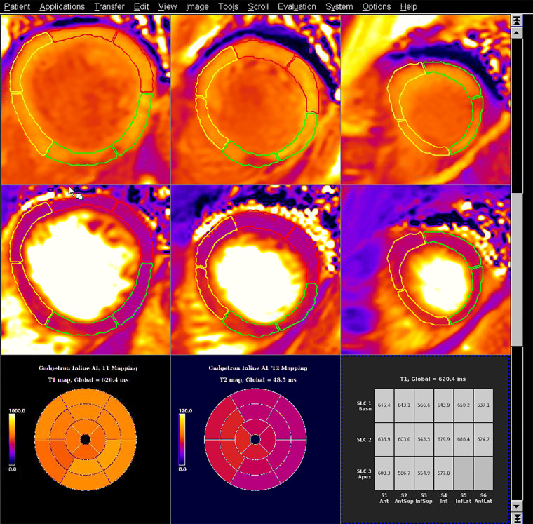 Example T1 and T2 maps from a patient with an acute inferoseptal (InfSep) infarct, with model inference running on the scanner at Hammersmith Hospital on the 1.5-T Aera MRI scanner (Siemens Healthineers). The images show shortened postcontrast T1 relaxation times (top row) in the inferoseptum and septal edema (prolonged septal T2 relaxation times) (middle row). These data are summarized as bull’s-eye plots of median values for each of the 16 American Heart Association segments for T1 (bottom left) and T2 (bottom middle), as well as in tabular format (bottom right). The segmentation contours used in the calculations are overlaid on the T1 and T2 maps, as yellow lines (for septal segments), green lines (for inferior segments), and red lines (for anterior segments). This serves as explainable artificial intelligence (AI) and allows manual quality control by the reporter. Ant = anterior, AntLat = anterolateral, AntSep = anteroseptal, Inf = inferior, InfLat = inferolateral, SLC = section.